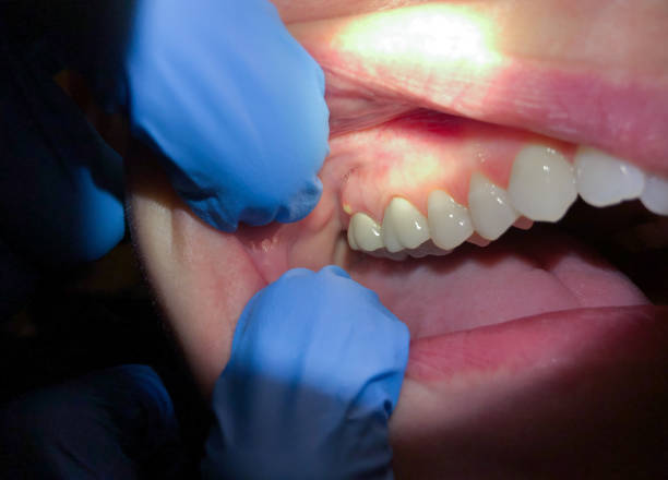 Best Emergency Dental Extractions in East Dennis, MA