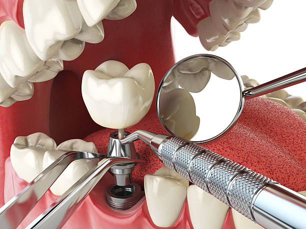 Best Emergency Dentist for Lost Fillings or Crowns in East Dennis, MA